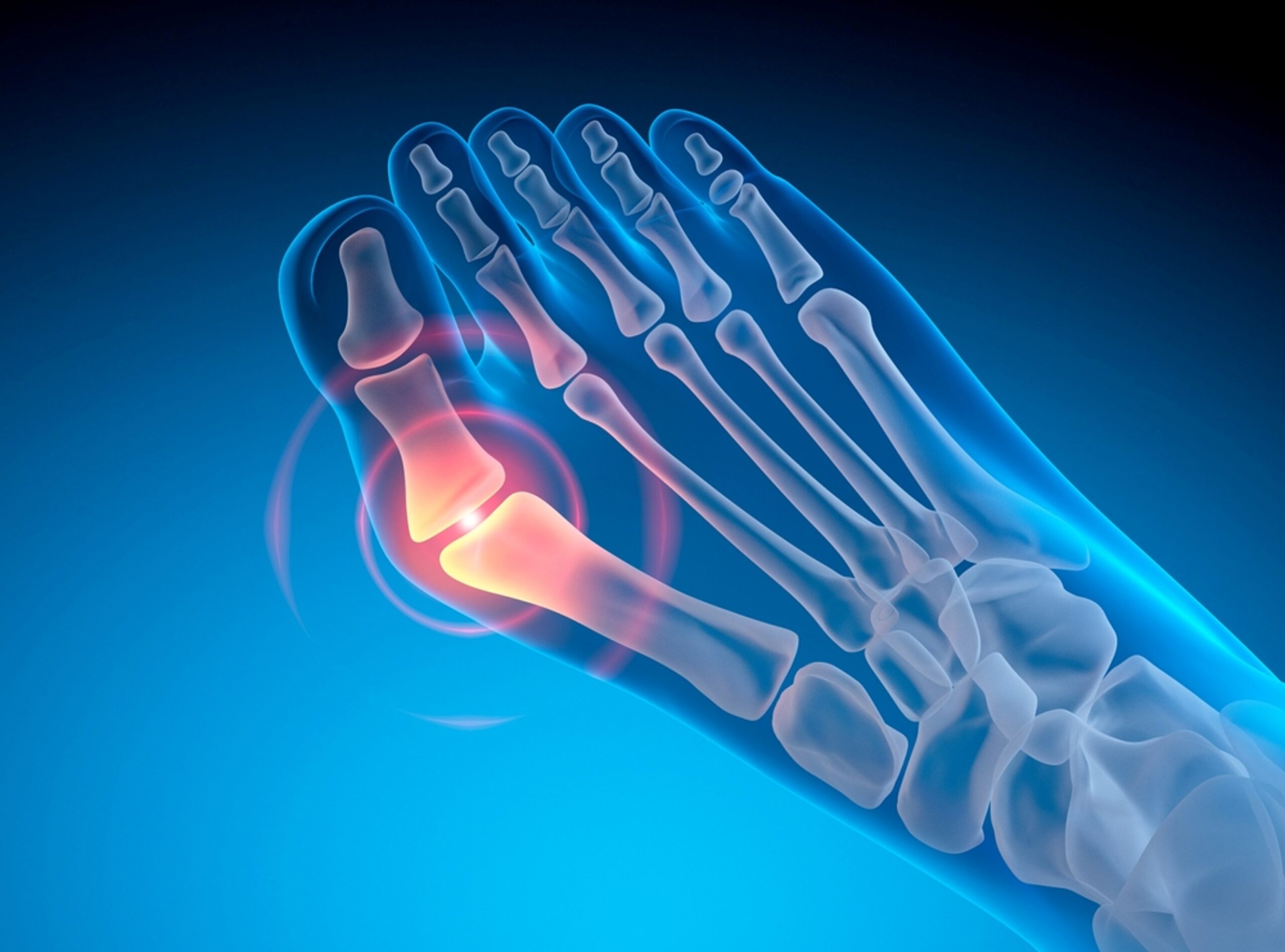 Hallux valgus: cum afectează mersul și ce poți face pentru confort?
