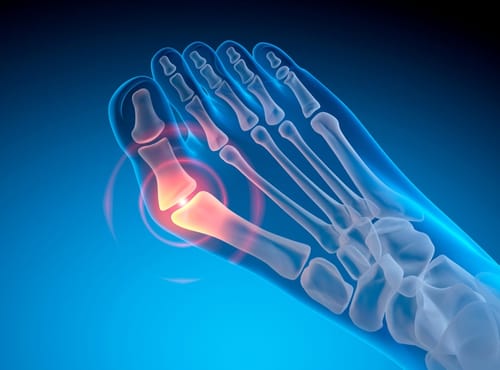 Hallux valgus: cum afectează mersul și ce poți face pentru confort?